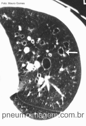 MANITOL EM P� PARA O TRATAMENTO DE BRONQUIECTASIAS